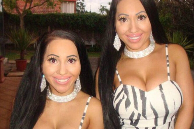 «Нам стыдно!». Сестры-близнецы жалеют о пластических операциях, которые сделали ради полной идентичности