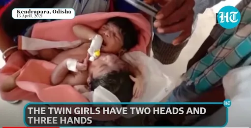 Новорожденные сиамские близнецы на руках у матери