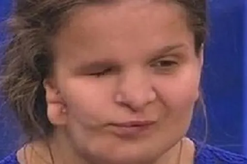 17-летняя Катя Бадаева с дефектом лица скончалась во время пластической операции