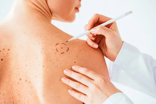 Не только кожа: 5 участков тела, на которых меланома развивается чаще всего