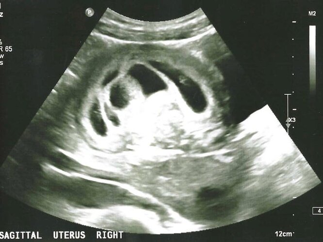 Первый УЗИ-снимок беременности