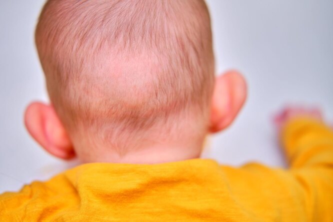 Почему у новорождённых выпадают волосы?
