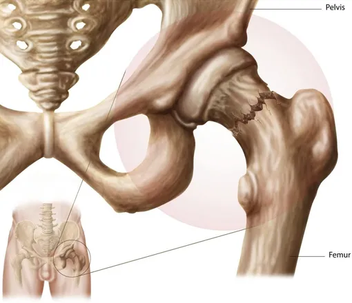 Что такое перелом шейки бедра и как его лечат: 16 вопросов травматологу-ортопеду