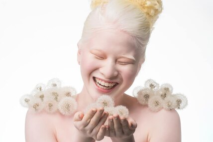 От девочки-альбиноса отказались родители. Она выросла и стала моделью