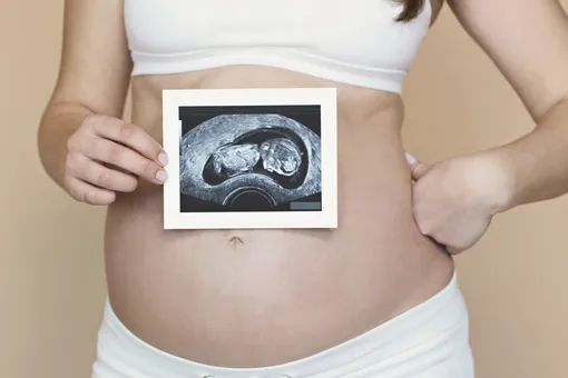 Женщина, которая родилась без матки, ждет первенца после пересадки органа