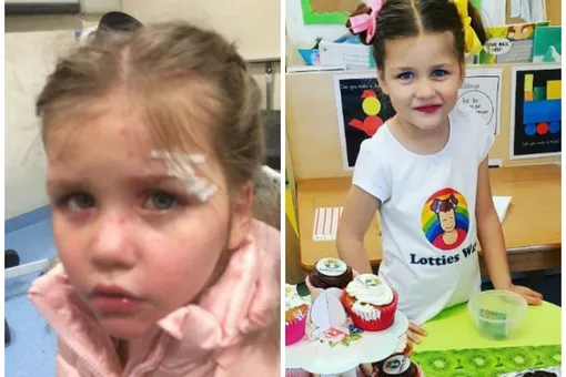3-летняя девочка перенесла инсульт из-за обычной ветрянки