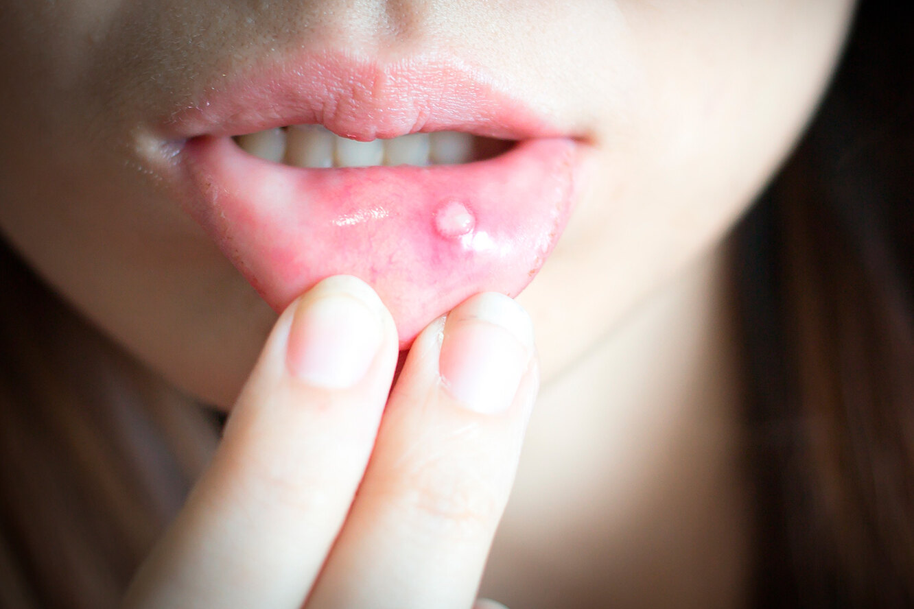 Что такое стоматит, симптомы стоматита, как лечить стоматит и ...