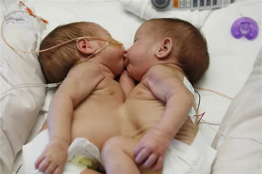 Малыши, рожденные сиамскими близнецами, начали отдельную жизнь