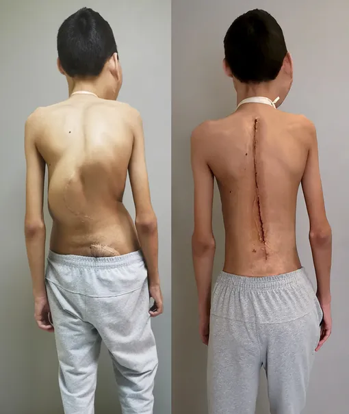 Мурат до и после операции — вид со спины