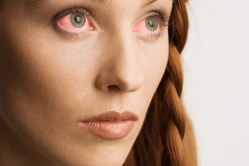 Женщина 7 лет лечила красные глаза. Пока не узнала истинный диагноз