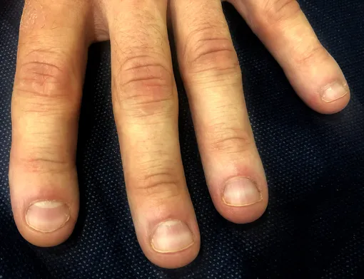 полосы на ногтях — «Читаем» ковид по ногтям: 5 признаков, что вы уже переболели коронавирусом