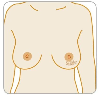 Самые частые симптомы рака груди, которые важно не пропустить: описание, иллюстрация