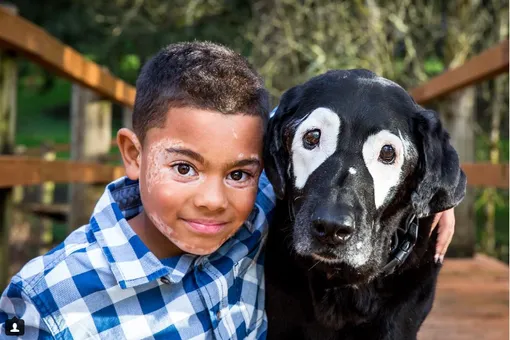 Мальчик подружился с собакой с такой же редкой болезнью, как у него