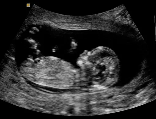 УЗИ в 20 недель беременности фото