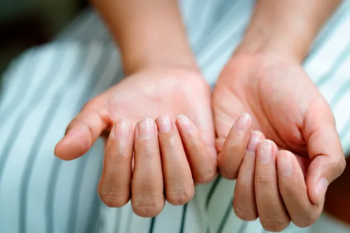 Симптомы и лечение меланомы ногтя: опасной болезни, которую нельзя пропустить
