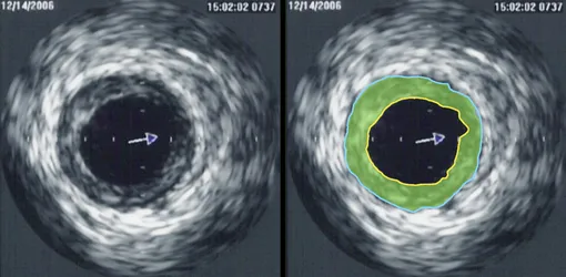Ультразвуковая диагностика выявила сужение венечной артерии. Зона бляшки отмечена зелёным цветом. Фото: wikipedia