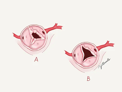 На картинке слева — стенозированный аортальный клапан (створки сращены), справа — нормальный.