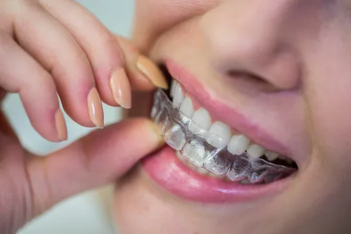 Каппы, как исправить неправильный прикус зубов