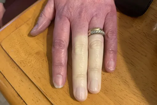 Совершенно белые пальцы: фото рук женщины с редким синдромом стало вирусным