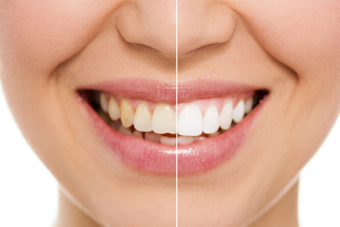 Как отбелить зубы в домашних условиях: 5 эффективных и безопасных способов