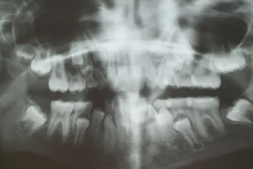 Врачи удалили семилетнему мальчику 526 лишних зубов