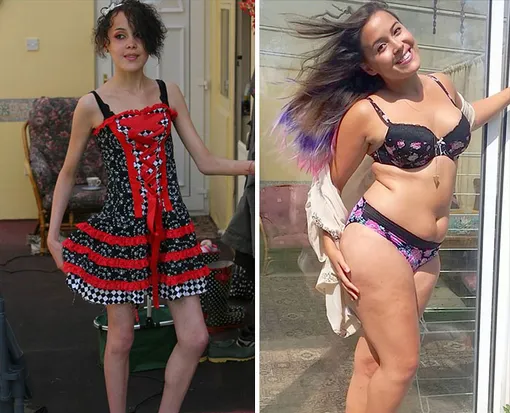 до и после анорексии