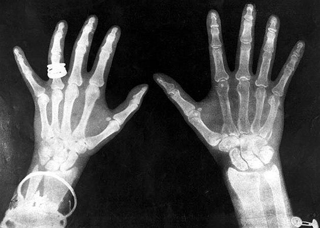 рентгеновский снимок кистей рук
