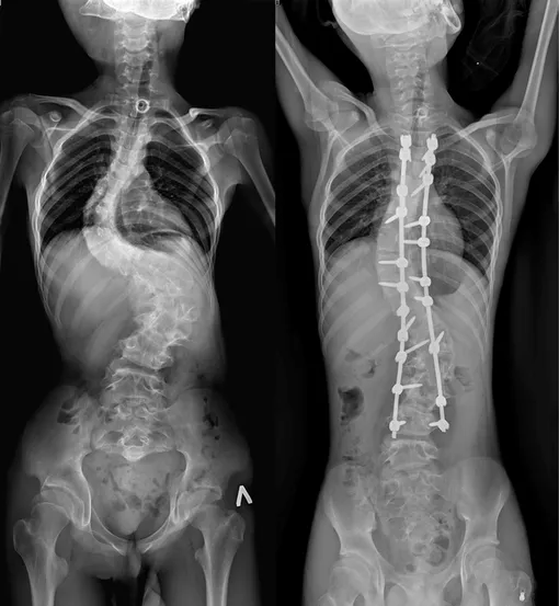 Рентгеновские снимки Мурата со спины до и после операции