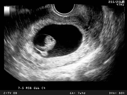 УЗИ-фото 7-недельного эмбриона