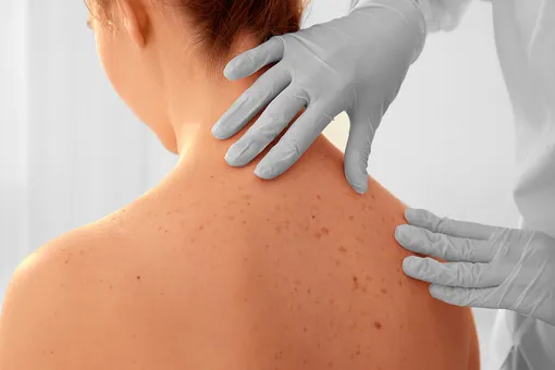 Рак кожи: 7 участков тела, которые мы не защищаем от УФ