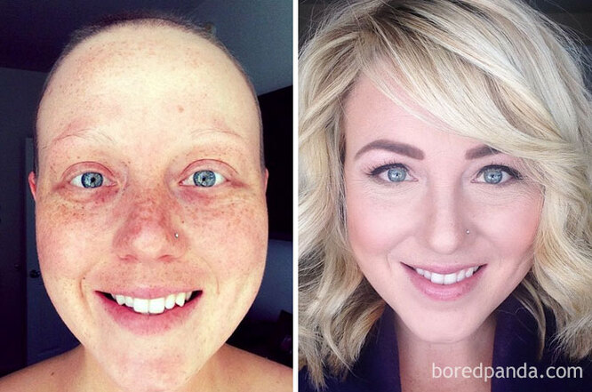 Они победили рак! 10 невероятных фотографий людей до и после болезни