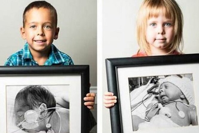 Выросшие дети, родившиеся раньше срока, показали свои первые фото