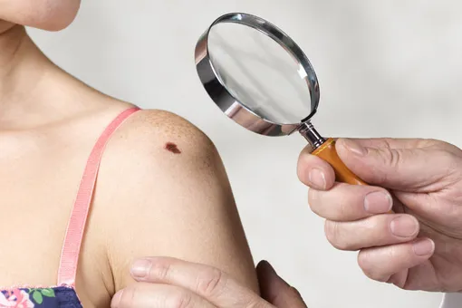10 новых фактов, которые помогут предотвратить рак кожи