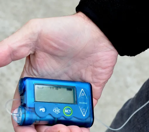 Инсулиновая помпа — стационарно установленный шприц фото
