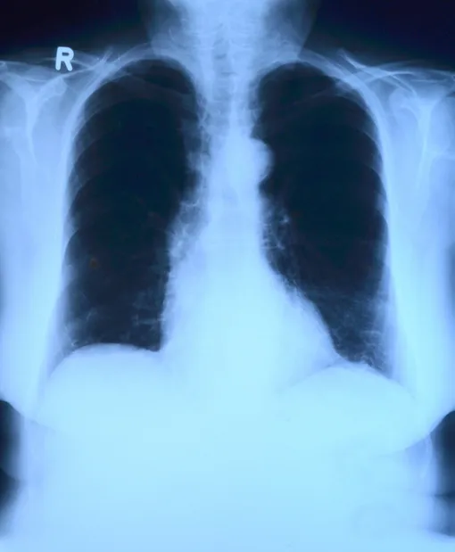 Рентген так же информативен в отношении легких, как и КТ фото