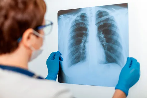 Узелки в лёгких: что это, чем опасны и когда пора обращаться к врачу