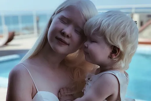 «Врачи были в шоке!»: невероятная история двух сестер-альбиносов из Казахстана