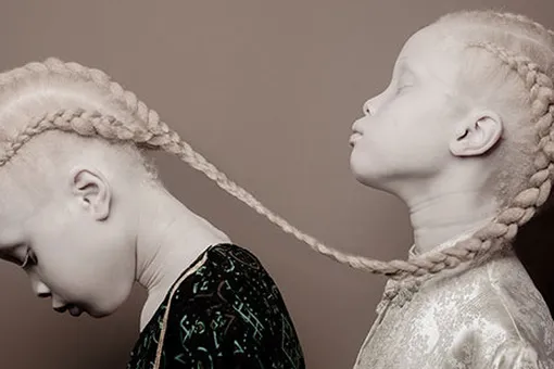 «Мы считаем, что это красиво». 11-летние сестры-альбиносы поразили весь мир