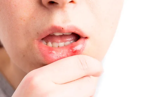 Стоматит — это довольно распространенные воспаления в полости рта, включая слизистые щек, языка и десен. Это состояние может быть довольно болезненным и привести к образованию язвочек. Самые частые причины этого — афтозный стоматит и герпес.