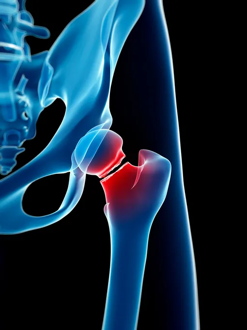 Что такое перелом шейки бедра и как его лечат: 16 вопросов травматологу-ортопеду