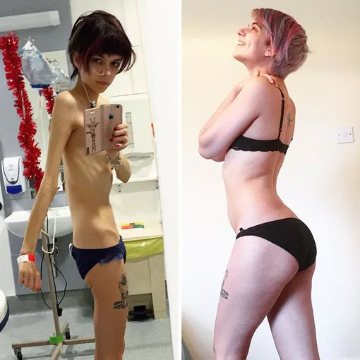 до и после анорексии