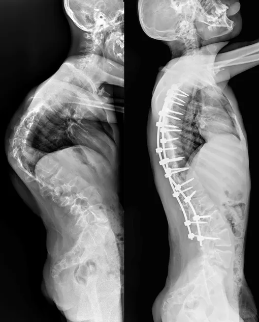 Рентгеновские снимки Мурата сбоку — до и после операции