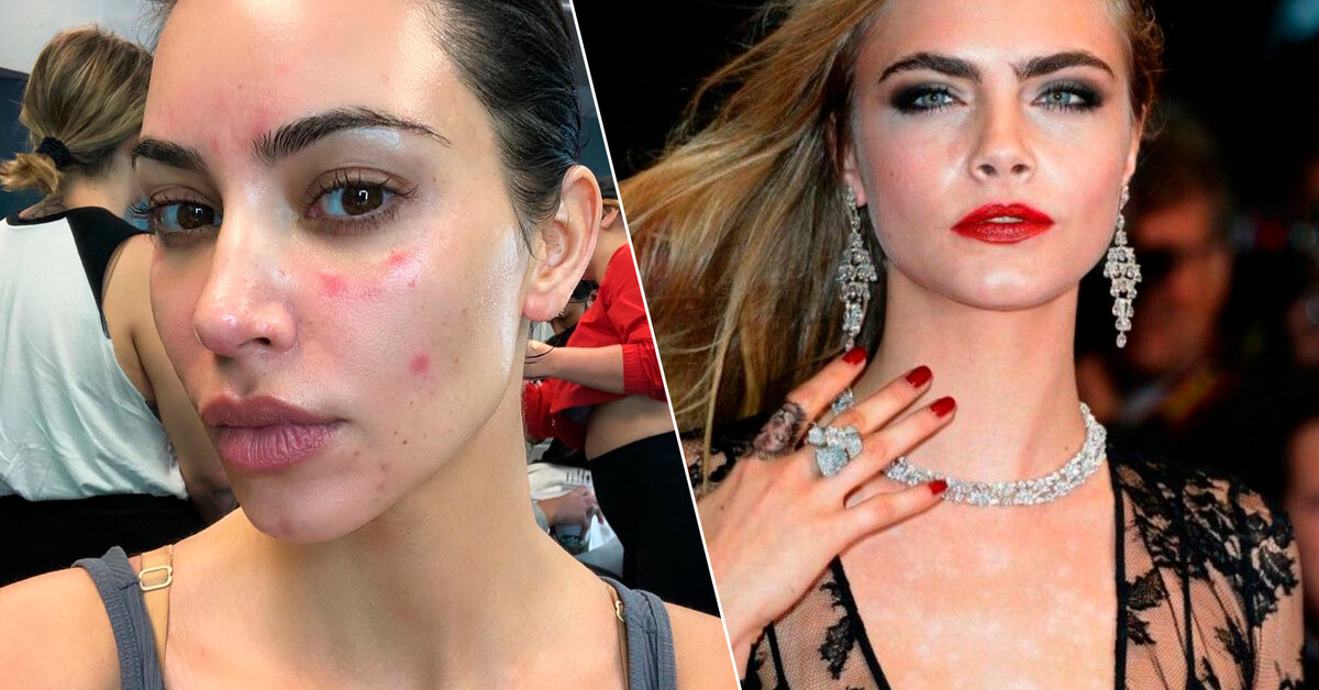 Знаменитости которые болели. Известные люди с эпилепсией. Йоланда перьера. Шеннен доэрти 2022. Известные люди с онкологией.