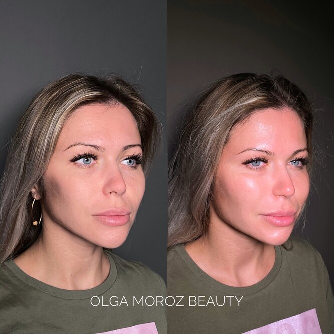 HydraFacial