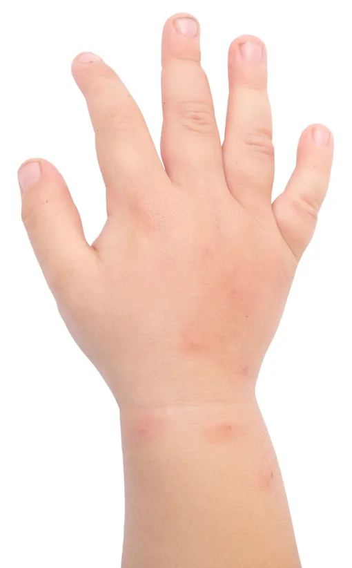 Аллергия на укусы комаров у детей проявляется быстрее и «ярче», чем у взрослых