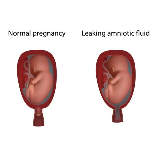 две матки — с нормальной беременностью и с подтекающими околоплодными водами
