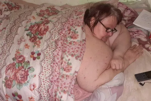 Самая большая женщина в мире похудела на 100 килограммов и впервые за 10 лет начала ходить (фото)