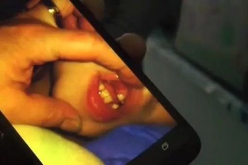 Семилетней девочке с аутизмом дети оторвали ухо и выбили зубы