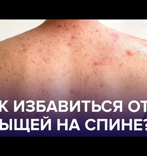 Как избавиться от прыщей на спине