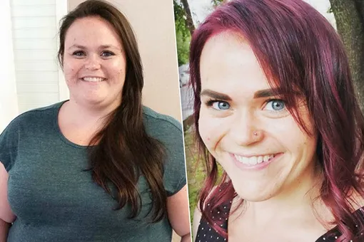 Похудеть с помощью скальпеля: женщина сбросила 60 кг после операции на желудке